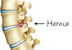 Hernia